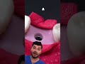 ایمپلنت دندان چیست 