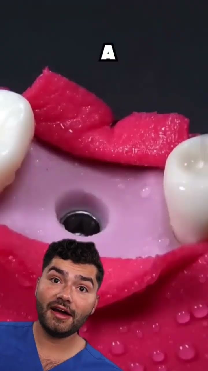 Dental Implant Explained !?
