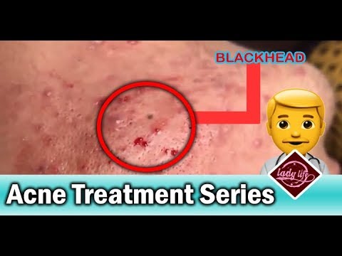 How to Get Rid of Blackheads, Cystic Acne, Whitehead on Nose, Acne Treatment Part: