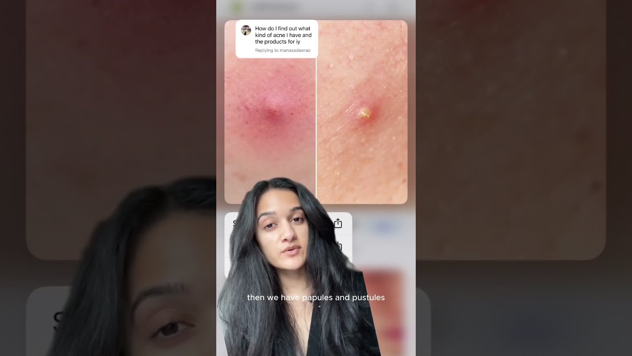 3 Main Types Of Acne And How To Treat Them