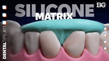 Silicone index technique for tooth restorations