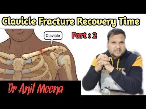 Clavicle bone fracture recovery time | clavicle bone Fracture treatment | collar bone | in hindi