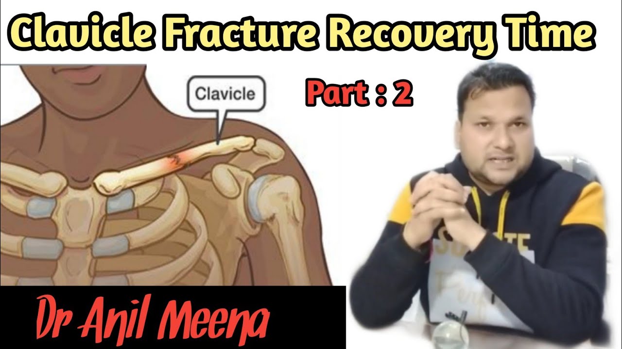 Clavicle bone fracture recovery time clavicle bone Fracture treatment collar bone in hindi