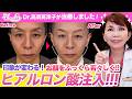 スッキリ若々しく!男性のヒアルロン酸注入を紹介します【くぼみ目】【こめかみ】【フェイスライン】