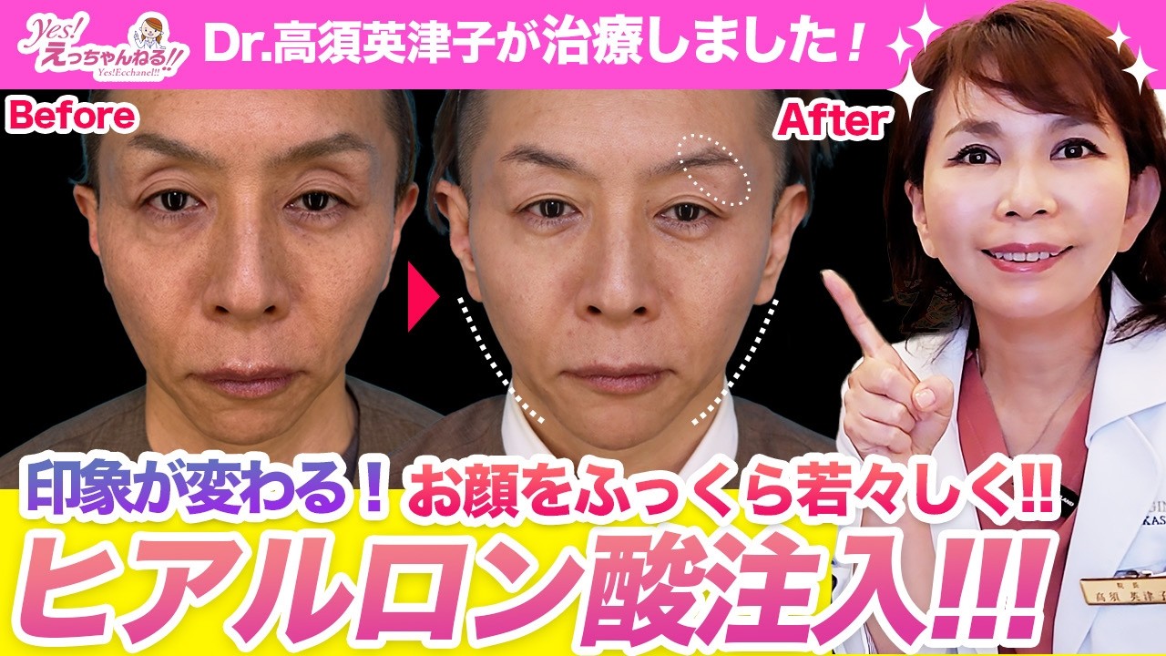 スッキリ若々しく!男性のヒアルロン酸注入を紹介します【くぼみ目】【こめかみ】【フェイスライン】