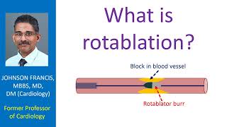 What is rotablation (Rotational atherectomy)? Intro
