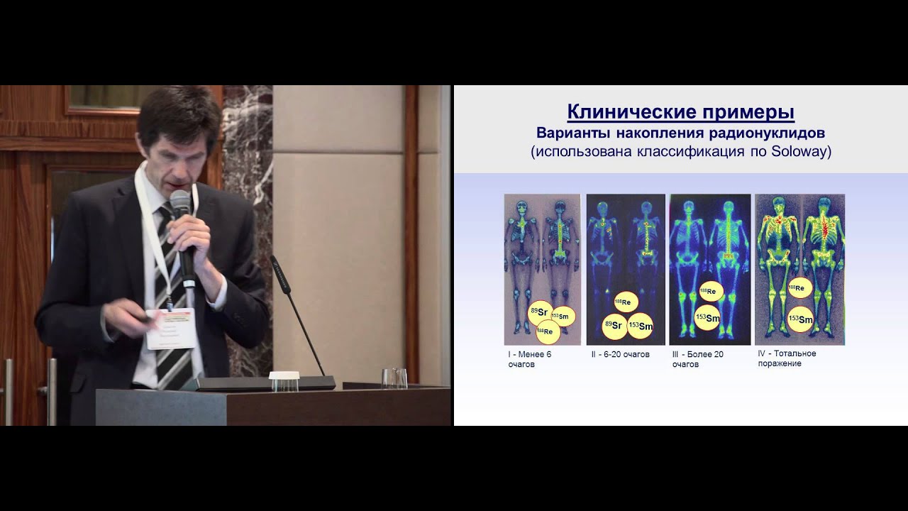 Радионуклидная терапия при метастазах в кости - YouTube