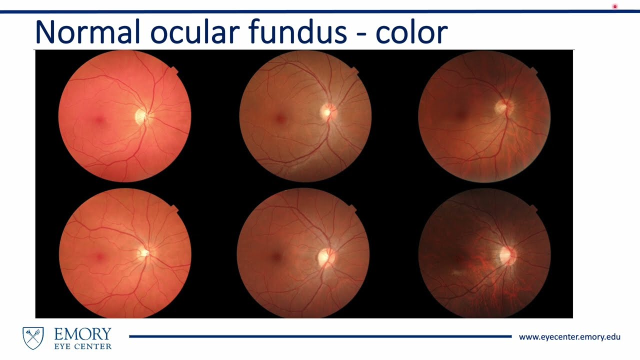 How to Interpret the Ocular Fundus of a Photograph from a Nonmydriatic Camera