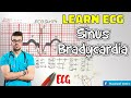 راجع معلوماتك بالإيقاع المتباطئ للقلب Learn ECG! Sinus Bradycardia