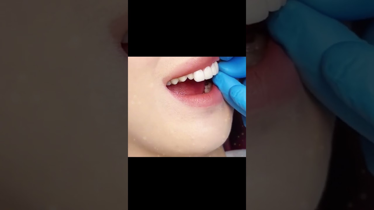 See a Smile Transformation Journey in 8Seconds