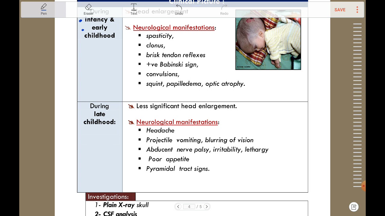 Hydrocephalus - Neurosurgery