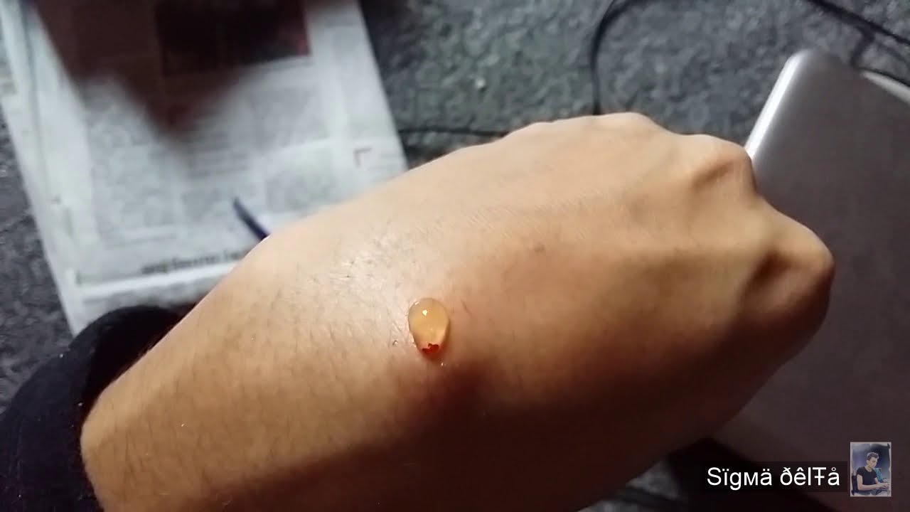 How to remove Ganglion Cyst without surgery on your own ...