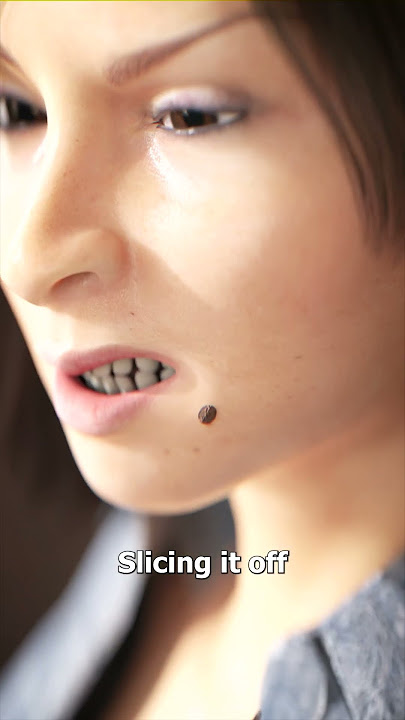 Should You Cut Off A Mole? 😬