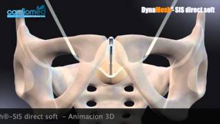 DynaMesh® SIS direct soft    Animacion 3D screenshot 2