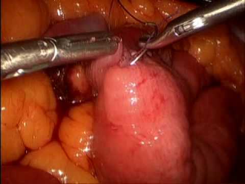 Laparoscopic Gastric Bypass (Roux en Y)