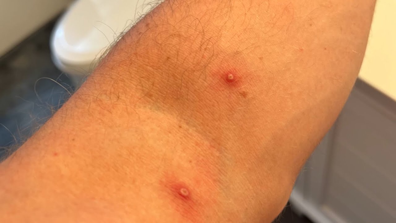Here's what we know about monkeypox in California YouTube