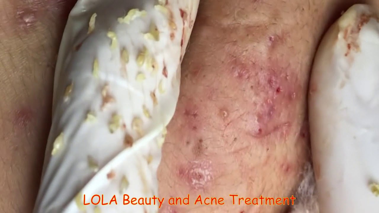 Satisfy Your Day; Blackheads, Whiteheads,  Acne Removal 23;  (Full Screen) Super Big Pops