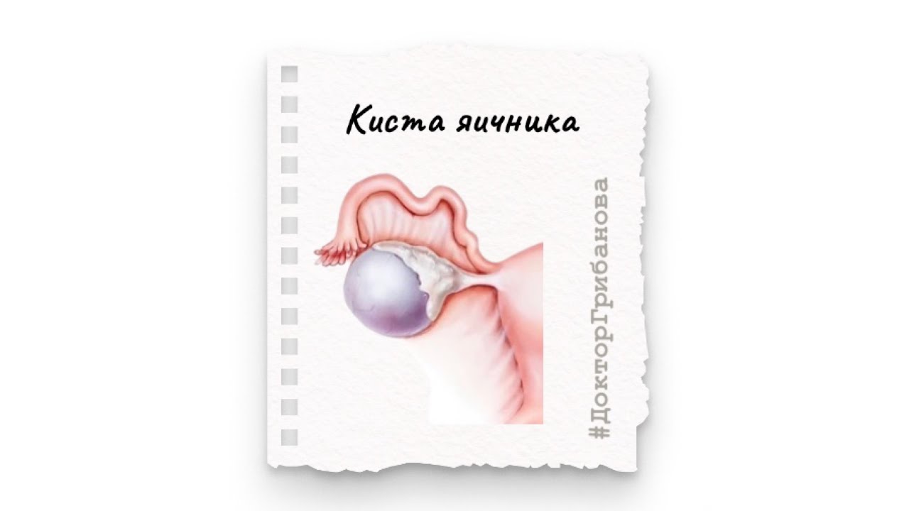 Удаление яичника можно забеременеть после. Параовариальные кисты яичников. Параовариальная киста мкб 10. Параовариальная киста слева.