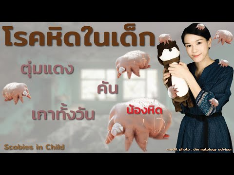 วีดีโอ: หิดในเด็ก: วิธีกำจัด