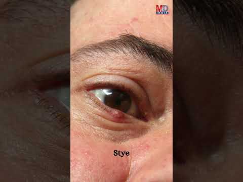 التهابات العين الشائعة خلال موسم الرياح الموسمية