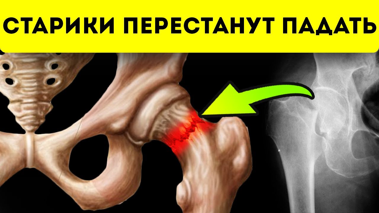 Врачи в ужасе! 8 признаков, что шейка бедра в опасности! Вот как ее ...