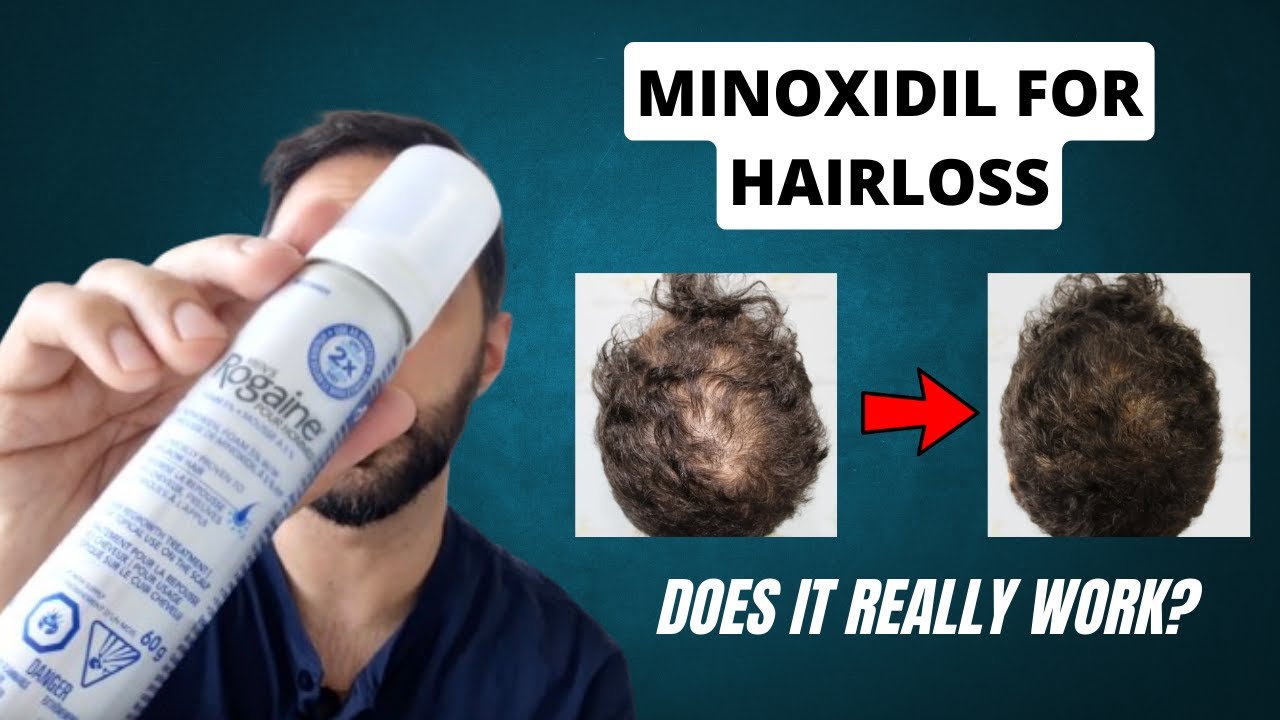 Does Minoxidil ACTUALLY fight hair loss?