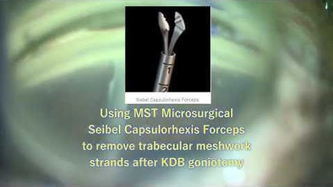 Using MST capsulorhexis forceps to remove trabecular meshwork strands after KDB goniotomy.