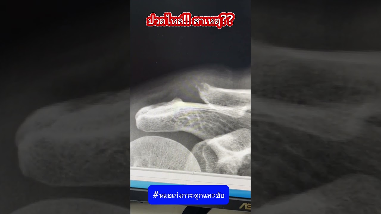 ปวดไหล่ สาเหตุ?? #หมอเก่งกระดูกและข้อ #ปวดไหล่ #ไหล่ติด #เอ็นไหล่ขาด #ข้อเสื่อม