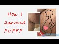 How I Survived PUPPP| PUPPP Pregnancy Rash