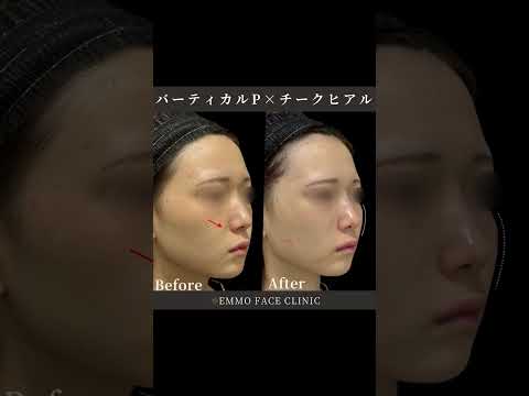 バーティカルＰ×貴族・チークヒアル