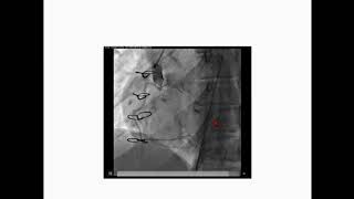 CVI2017 Challenging Case: My Institution's Interesting STEMI - Amir Solhpour, MD