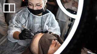 Bald men turn to grey-market scalp tattoos