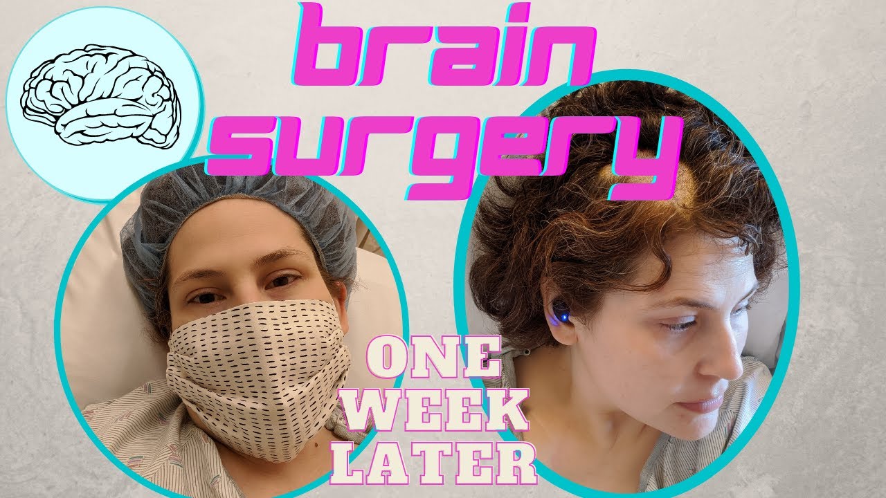 Brain Surgery Update: How I'm Doing One Week After