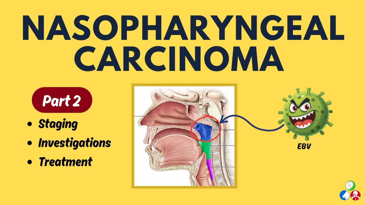 Nasopharyngeal Carcinoma (NPC) Part 2 | Staging | Diagnosis | Treatment ...