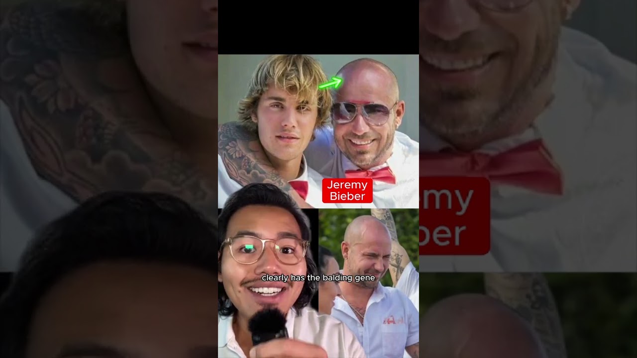 Justin Bieber (SECRET) hair loss battle 