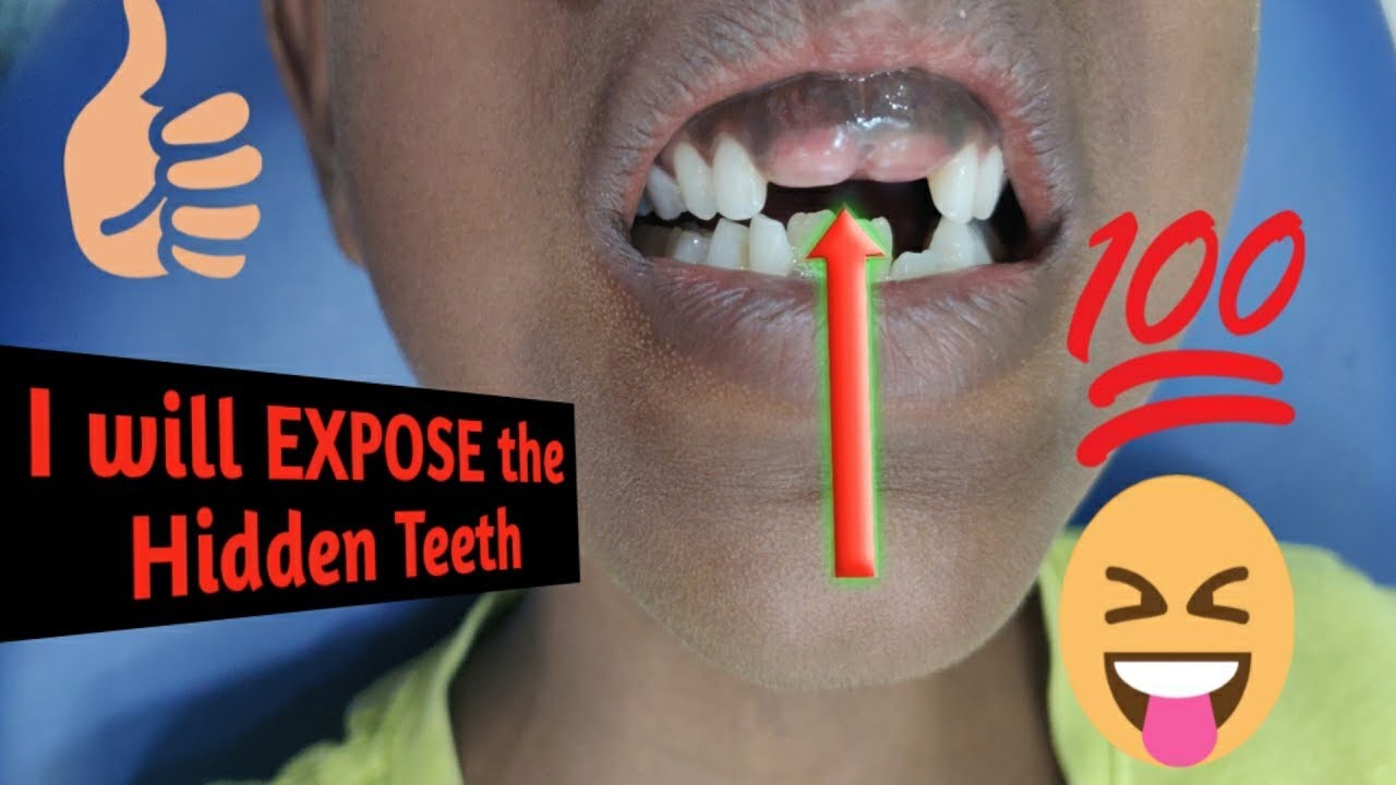 Surgical Exposure of Erupting Teeth - YouTube