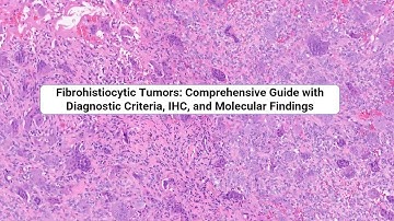 Fibrohistiocytic Tumors: Comprehensive Guide with Diagnostic Criteria, IHC, and Molecular Findings