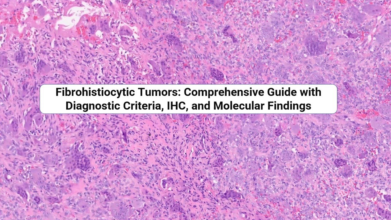 Fibrohistiocytic Tumors: Comprehensive Guide with Diagnostic Criteria, IHC, and Molecular Findings
