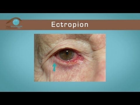 Entropion and Ectropion