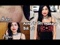 MAKEUP TUTORIAL FOR ACNE PRONE SKIN | How To Hide Acne & Pigmentation With Makeup | Nidhi Chaudhary