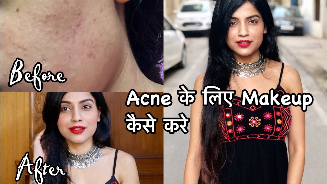 MAKEUP TUTORIAL FOR ACNE PRONE SKIN How To Hide Acne & Pigmentation