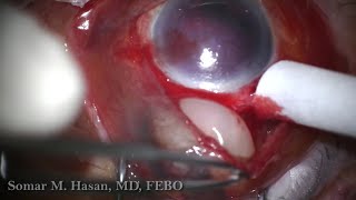 Expulsed Subconjunctival Crystalline Lens In Ruptured Globe Following Blunt Trauma