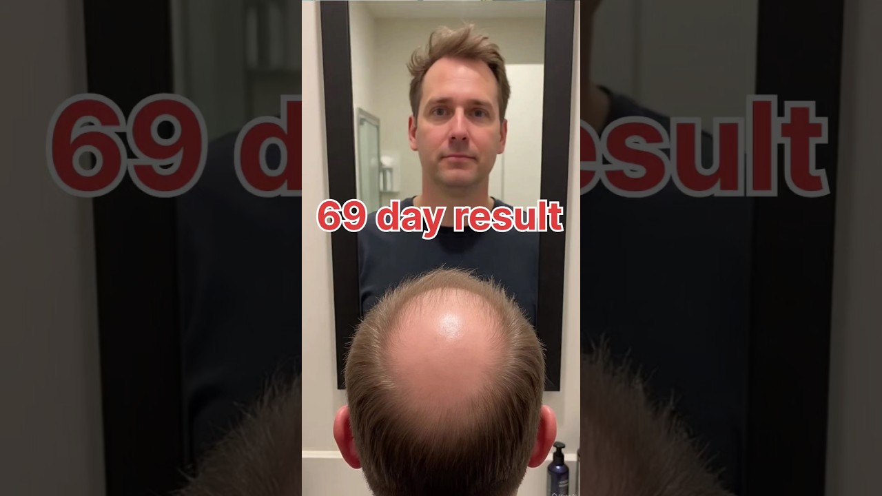 69 Din Mein Badal Gaya Sab | DHT Blocker + Minoxidil Magic 💥