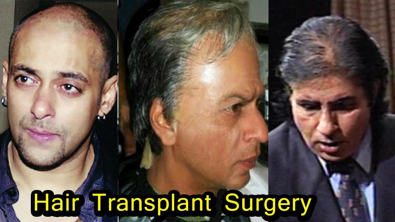Who are the bald actors in Bollywood opted for hair transplant or wears  wig  Quora