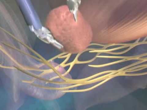 Prostate Robotic Surgery at Rex Hospital - Rex HealthBreak