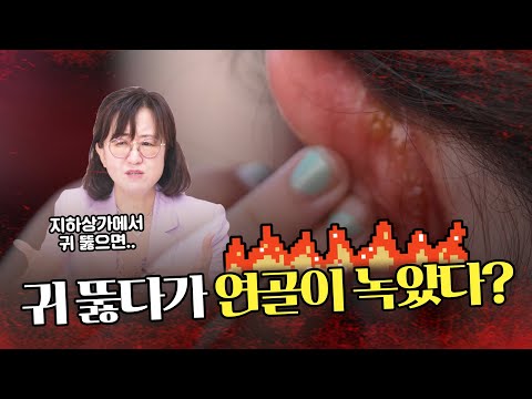 🔥귀 잘못 뚫으면 연골이 썩을 수도?!🔥 - [언니네피부과]