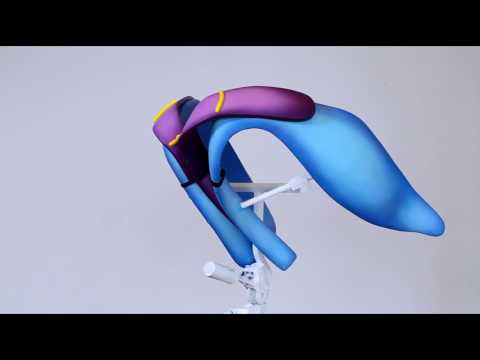 Video thumbnail: T Graft — Geoffrey W. Tobias, M.D.