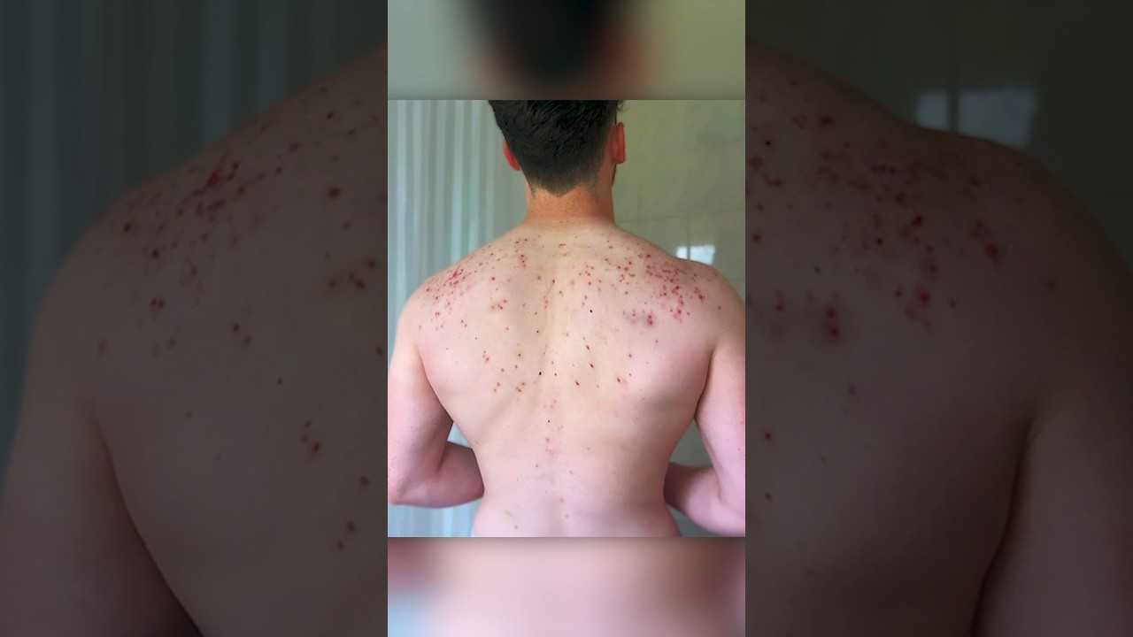Tips To Clear BACK ACNE Fast! 