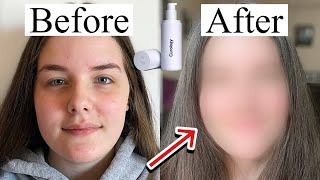 I Tried Curology for 30 Days! *free trial*