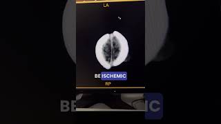 Neonatal Brain CT | Myelination vs Ischemia #shorts